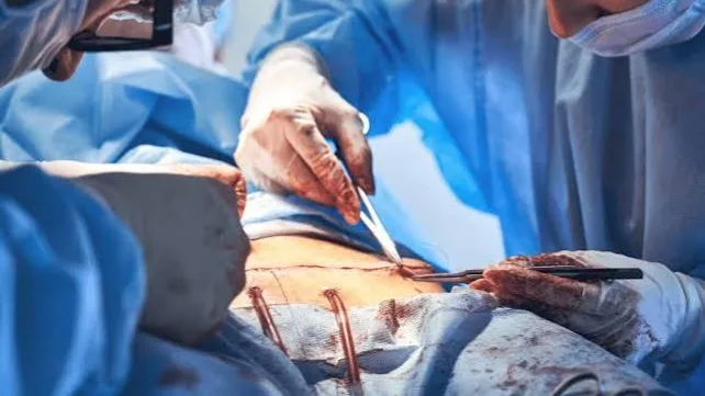 Corte Constitucional aclara condiciones para que las EPS autoricen la abdominoplastia