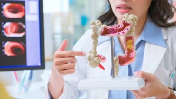 CÁNCER DE COLON EN COLOMBIA: CIFRAS, SÍNTOMAS Y PREVENCIÓN
