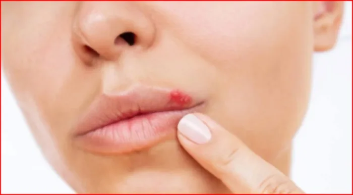 Herpes Zoster