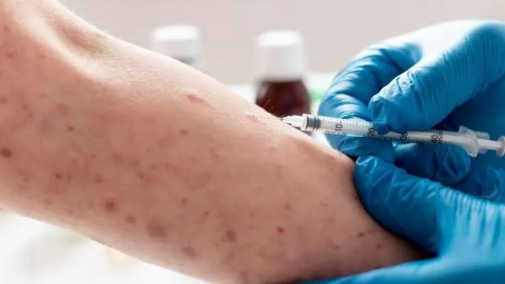 Sarampión llega desde Perú y activa las alertas sanitarias en Colombia