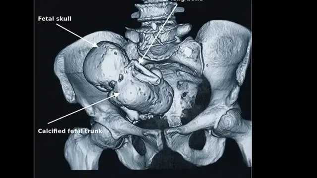 mujer descubre un feto calcificado tras tres años de dolor abdominal