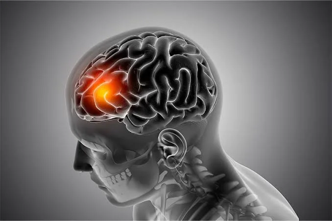 Accidente cerebro vascular