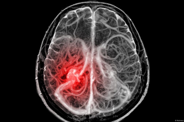 Niño de 13 años en Francia logra curarse de un cáncer cerebral mortal