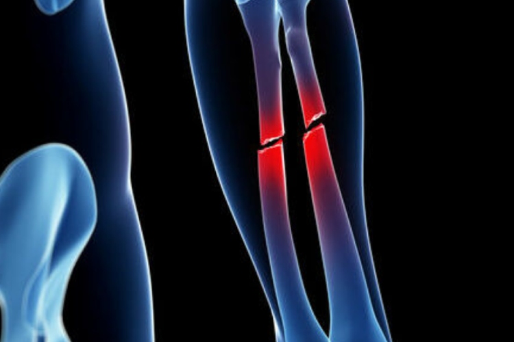 China desarrolla biopegamento que repara huesos en minutos