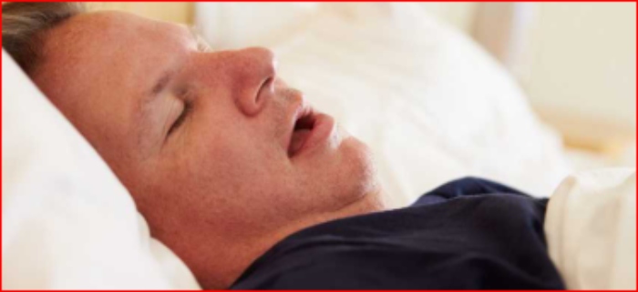 roncar- salud- sueño- divorcio- poliposis nasal-